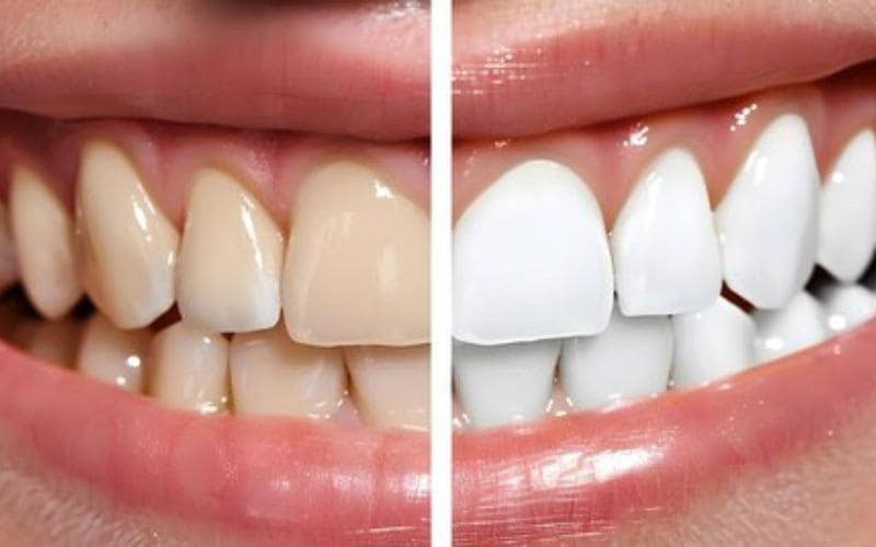 Smile Transformation Posts