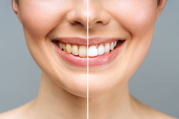 Use Before-and-After Smile Ads